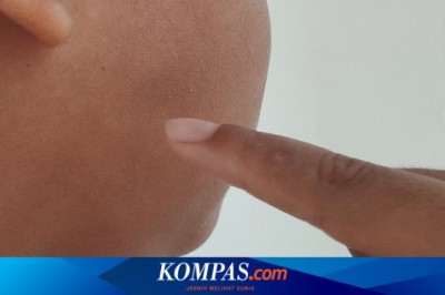 Gondongan Meningkat di Kabupaten Malang, Waspadai Komplikasi Serius